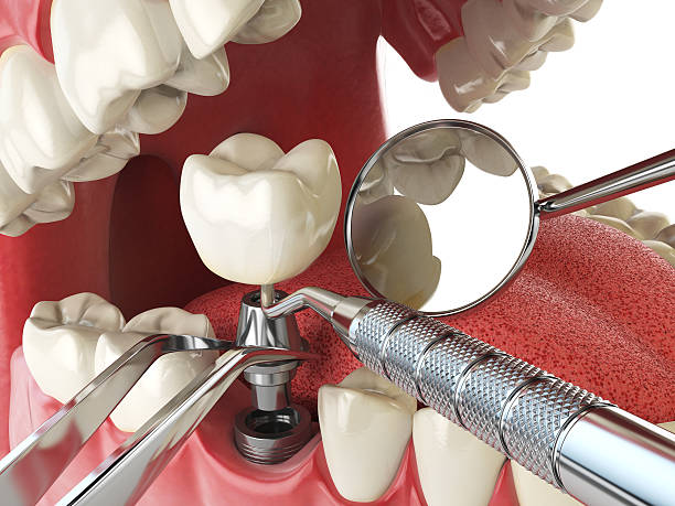 Best Emergency Treatment for Toothache in Hamton, IL